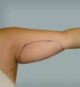 Laserlipolisi (liposuzione laser) - Intervento di Liposuzione Laser in sedazione locale alle braccia