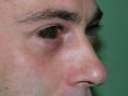 Dott. Pier Luigi Gibelli - Blefaroplastica inferiore con rimozione delle borse adipose per via transcongiuntivale senza cicatrici visibili