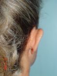 Operazione orecchie (Otoplastica) - Foto del prima - Prof. Franco MIGLIORI