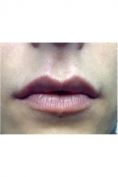 Aumento labbra - Foto del prima - Dott. Carlo Lampignani