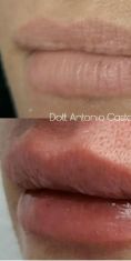 Aumento labbra - Foto del prima - Antonio Castagna