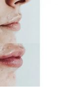 Aumento labbra - Foto del prima - Dr Uberto Giovannini