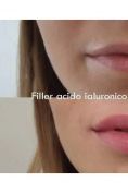 Aumento labbra - Foto del prima - Cliniche Novagenesis - Dott.  Alberto Rossi Todde