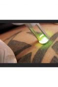 Rimozione tatuaggi - laser - Foto del prima - Dott. Giulio Maria Maggi Chirurgo plastica