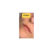 Aumento labbra - Foto del prima - Dott.ssa Olena Zinchenko