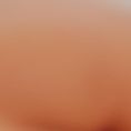 Mastoplastica additiva - - età 40-49 anni, corporatura robusta, seno 3a scarsa, forma appiattita, polo superiore svuotato, torace curvo e di media altezza; capezzoli divergenti, asimmetrie  capezzoli (più basso e divergente a destra) e dimensione mammella (più a sin)
- impianto dual plane modificato riggio di protesi anatomiche con incisione solco sottomammario
- risultato seno mis. 4a
- protesi 410  altezza piena, proiezione extra fx 450 grammi