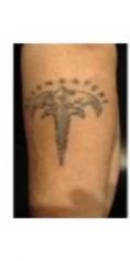 Rimozione tatuaggi - laser - Foto del prima - Dott. Giorgio Russo