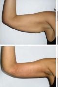 Lifting delle braccia - Foto del prima - Dott. Antonio  Tambuscio M.D.