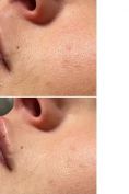 Aumento labbra - Foto del prima - Dr. Mario Gioia