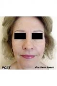 Lifting viso - Foto del prima - Dott.ssa Sara Russo
