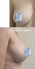 Mastopessi (Lifting del seno) con protesi - Foto del prima - Dott. Egidio Riggio