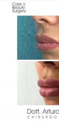 Aumento labbra - Foto del prima - Dott. Arturo Amoroso