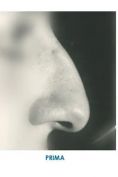 Rinoplastica - Foto del prima - Dott. Angelo  Scioli