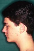 Operazione orecchie (Otoplastica) - Otoplastica con correzione dell
