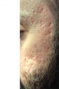 Acne laser, Cicatrici da acne laser - Foto del prima - Dott. Tommaso Savoia Med