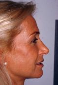 Rinoplastica - Correzione del dorso e della punta nasale. Un grande vantaggio della rinoplastica chiusa sono le cicatrici invisibili che vengono nascoste all