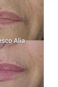 Aumento labbra - Foto del prima - Dott. Francesco Alia