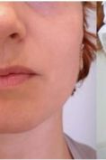 Aumento labbra - Foto del prima - Dott.ssa Sara Russo