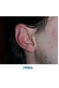 Operazione orecchie (Otoplastica) - Foto del prima - Dott. Angelo  Scioli