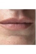 Aumento labbra - Foto del prima - Cliniche Novagenesis - Dott.  Alberto Rossi Todde