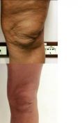 Liposuzione - Foto del prima - Dott. Giulio Maria Maggi Chirurgo plastica