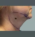 Laserlipolisi (liposuzione laser) - Intervento di Liposuzione Laser in sedazione locale doppio mento.