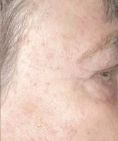 Asportazione nei,  Rimozione nei - Foto del prima - Skin Laser Clinic