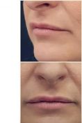 Aumento labbra - Foto del prima - Dott. Andrea Manconi