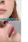 Aumento labbra - Foto del prima - Dott. Antonio  Tambuscio M.D.