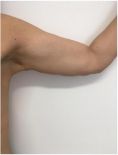 Lifting delle braccia - Foto del prima - Dott. Angelo  Scioli