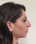 Rinoplastica - Settorinoplastica primaria. Importante riduzione del volume della piramide nasale intervenendo su ossa nasali, cartilagini triangolari, alari, setto e spina nasale anteriore. Deproiezione e rotazione della punta. Armonizzazione del profilo.