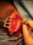 Operazione orecchie (Otoplastica) - Foto del prima - Dr. Luigi Maria Lapalorcia Specialista in Chirurgia Plastica Ricostruttiva ed Estetica