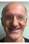 Operazione orecchie (Otoplastica) - Foto del prima - Dott. Antonino CAMPISI chirurgo plastico estetico