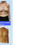 Ricostruzione del seno - Foto del prima - Dr. Pietro Loschi