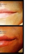 Aumento labbra - Foto del prima - Dott. Umberto Napoli