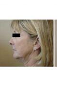 Mesoterapia (rivitalizzazione del viso, collo, decoltè, mani) - Foto del prima - Dott. NICOLA CATANIA