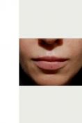 Ingrandimento labbra con grasso (lipofilling) - Foto del prima - LaCLINIQUE of Switzerland®