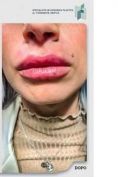 Aumento labbra - Foto del prima - Dott. Fioravante Orefice