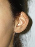Operazione orecchie (Otoplastica) - Foto del prima - Dott. Alessandro Covacivich