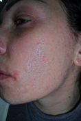 Acne laser, Cicatrici da acne laser - Foto del prima