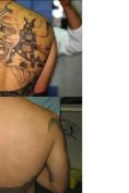 Rimozione tatuaggi - laser - Foto del prima - Prof. Franco Buttafarro