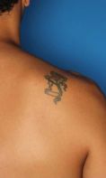 Rimozione tatuaggi - laser - Foto del prima - Cliniche Novagenesis - Dott.  Alberto Rossi Todde