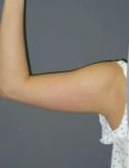 Lifting delle braccia - Foto del prima - Skin Laser Clinic