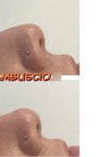 Rinoplastica non chirurgica - Foto del prima - Dott. Antonio  Tambuscio M.D.