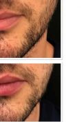 Aumento labbra - Foto del prima - Dott.ssa Giulia Bianchi