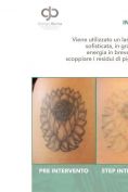 Rimozione tatuaggi - laser - Foto del prima - Dott. Giorgio Berna M.D.