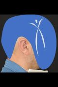 Operazione orecchie (Otoplastica) - Foto del prima - Dott. Leonardo Michele Ioppolo Md