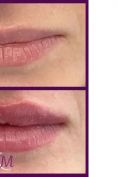 Aumento labbra - Foto del prima - Dr. Luciano Perrone