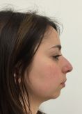 Dott. Tito Marianetti - Settorinoplastica primaria. Deproiezione e rotazione della punta nasale. Asportazione della spina nasale anteriore ipertrofica.Regolarizzazione del dorso nasale. Armonizzazione del profilo.