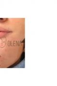 Aumento labbra - Foto del prima - Dott.ssa Olena Zinchenko